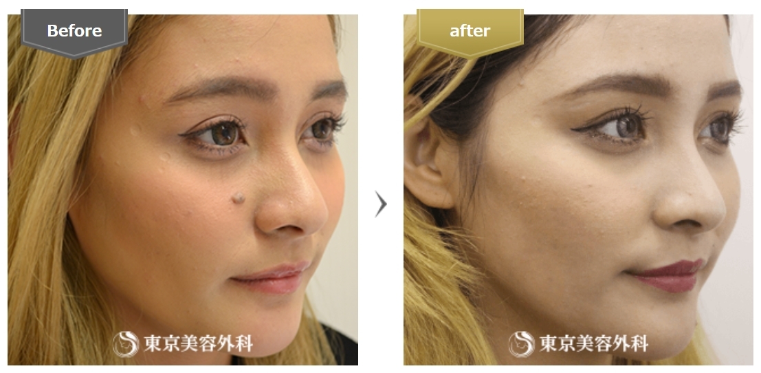 梅田でほくろ除去がおすすめで人気の東京美容外科のビフォーアフター