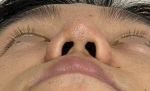 隆鼻術（プロテーゼ）の症例写真