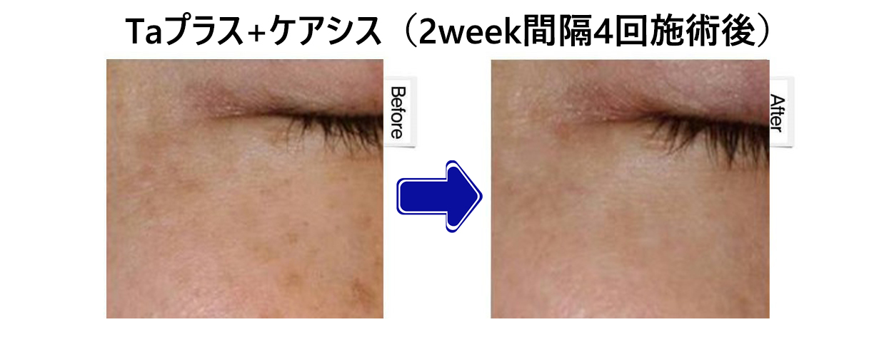 CARESYS