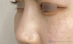 隆鼻術（プロテーゼ）の施術後症例写真