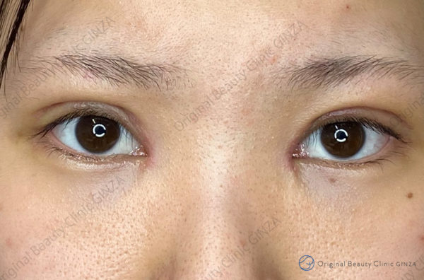 目の上のたるみ取りの施術後症例写真