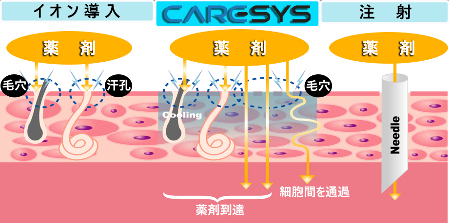CARESYS