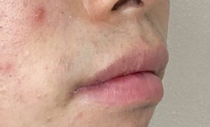 唇を薄くの施術後の症例写真