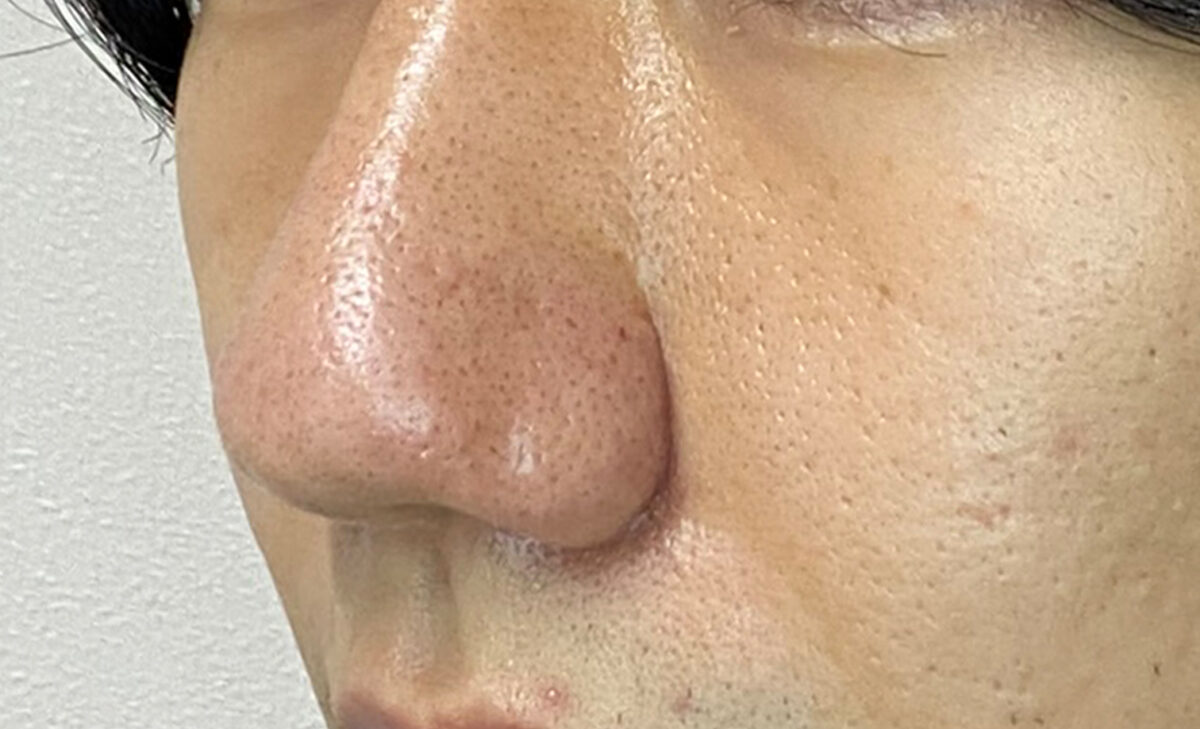 小鼻縮小術の症例写真