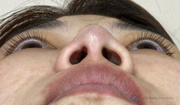 鼻尖形成（オステオポア/オステオポール）の施術後症例写真