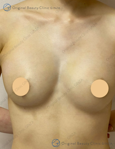 正面ヒアルロン酸豊胸術後の症例写真
