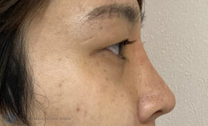ヒアルロン酸（鼻根）の症例写真