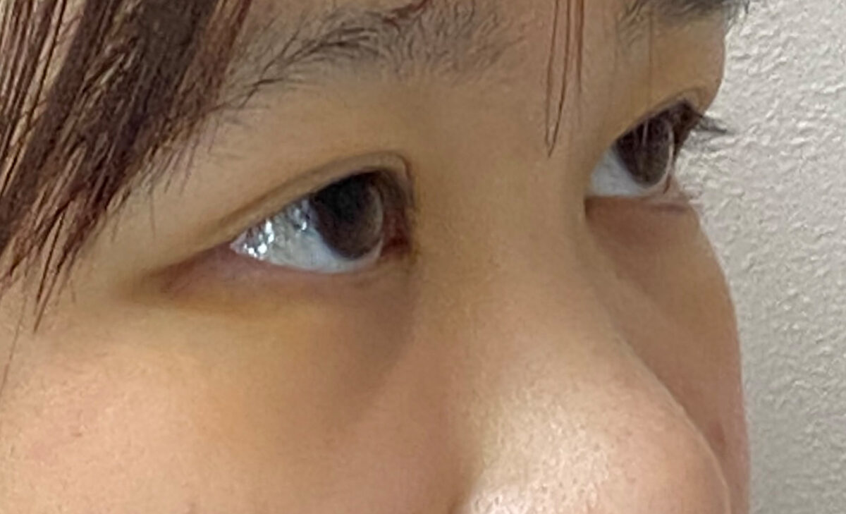 二重（埋没法）の症例写真