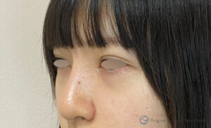 隆鼻術（プロテーゼ）の症例写真