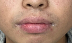 唇を薄くの施術前の症例写真