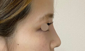 ヒアルロン酸（鼻根）の症例写真