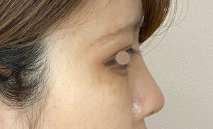 耳介軟骨移植・隆鼻術施術後症例写真