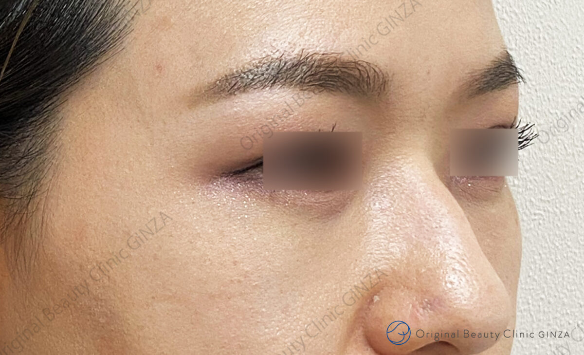 目の下のふくらみ取りの施術後症例写真