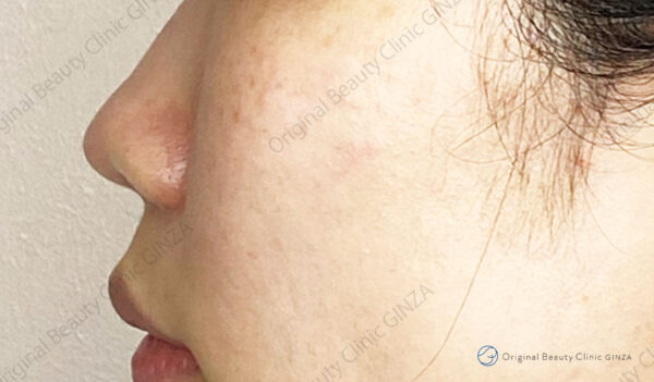 鼻尖形成（オステオポア/オステオポール）の施術後症例写真