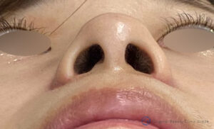 小鼻縮小術の症例写真