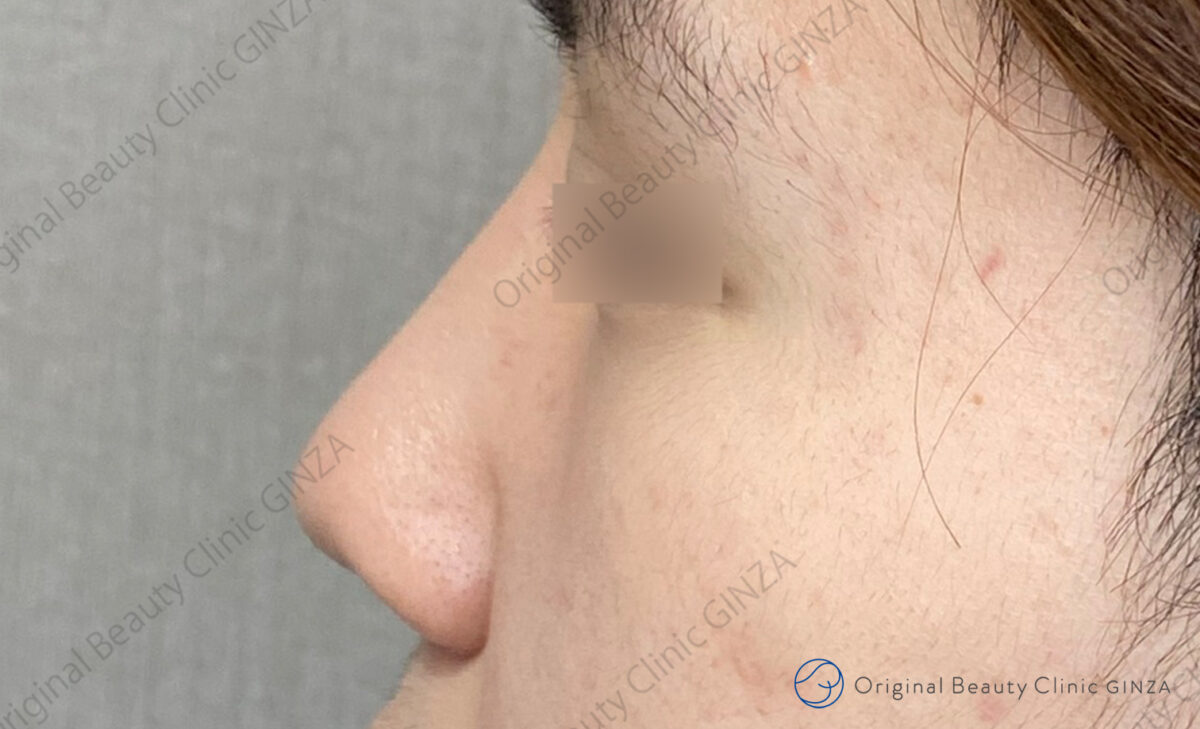 隆鼻術（プロテーゼ）の施術後症例写真