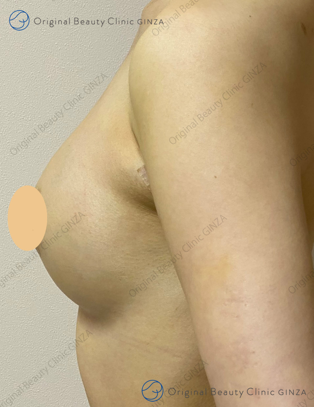 横向きヒアルロン酸豊胸術後の症例写真