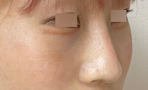 隆鼻術・耳介軟骨の症例写真