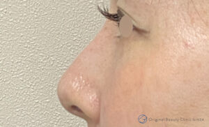 隆鼻術の症例写真