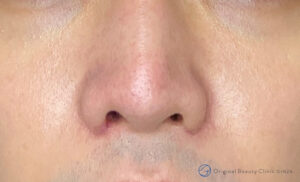 小鼻縮小術（切開法）の施術後症例写真
