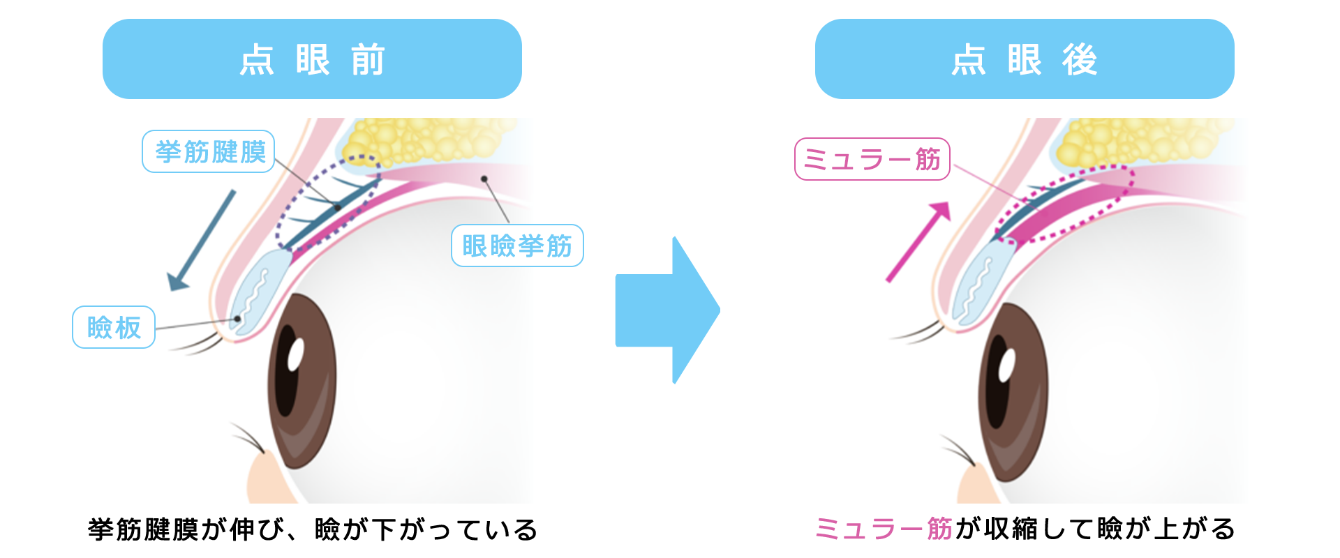 アップニーク