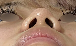 小鼻縮小術（外側）の症例写真