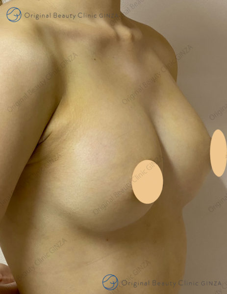 ヒアルロン酸豊胸術後の斜めからの症例写真