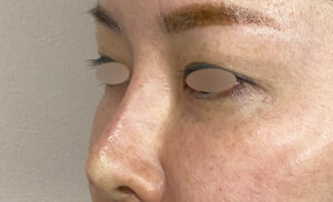 ヒアルロン酸（鼻）の症例写真