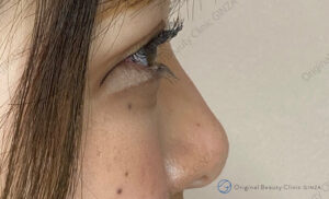 ヒアルロン酸（鼻）の施術後症例写真