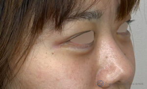 ヒアルロン酸（涙袋）の施術後症例写真