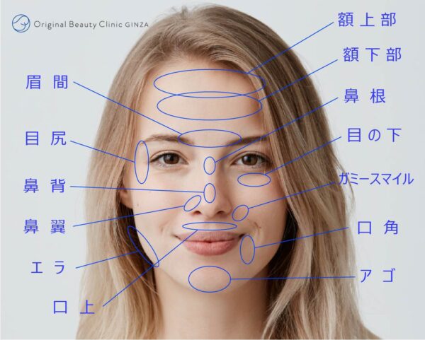 ボトックスの注射部位画像