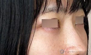 目の下のふくらみ取りの施術後症例写真