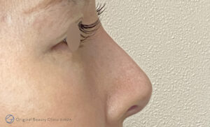 隆鼻術の症例写真