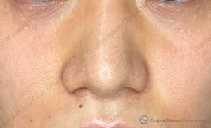 小鼻縮小術（切開法）の施術後症例写真